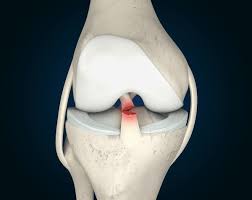 Sports Medicine